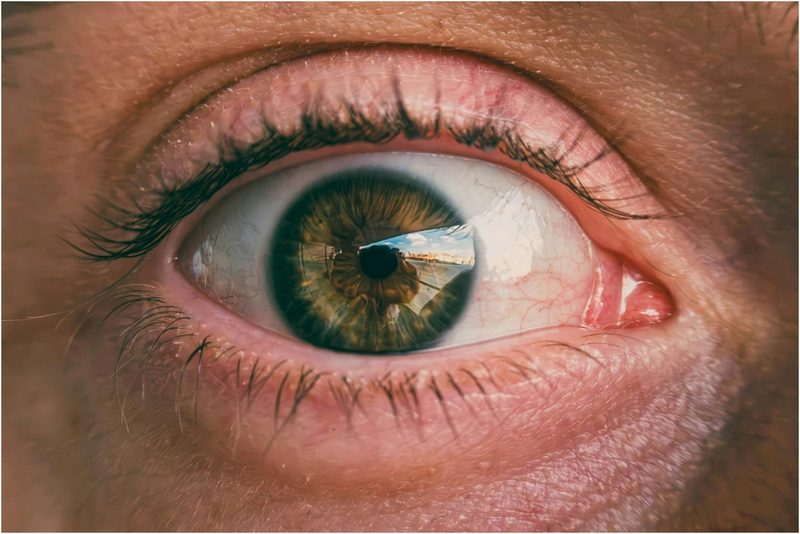 Catarata em idosos: sinais, cirurgia e recuperação, olho catarata, cirurgia oftalmológica
