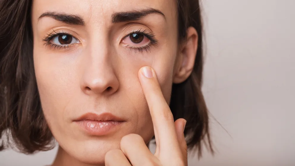 Pessoa com ardor e irritação nos olhos, tocando suavemente a região abaixo da pálpebra