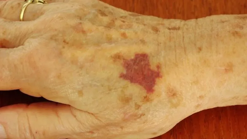 Mancha roxa no dorso da mão de uma pessoa idosa, compatível com equimose