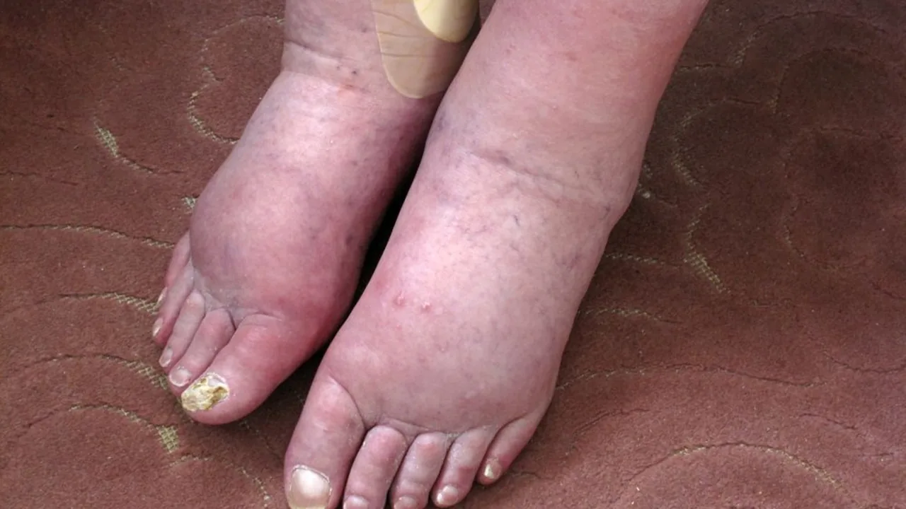 Pés e tornozelos com inchaço, exemplo visual de edema
