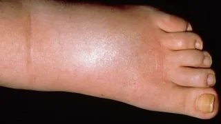 Pé com área de pele esticada e inchada, exemplo de edema observado no corpo