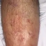 Inchaço nas pernas em idosos: causas, cuidados e sinais de alerta