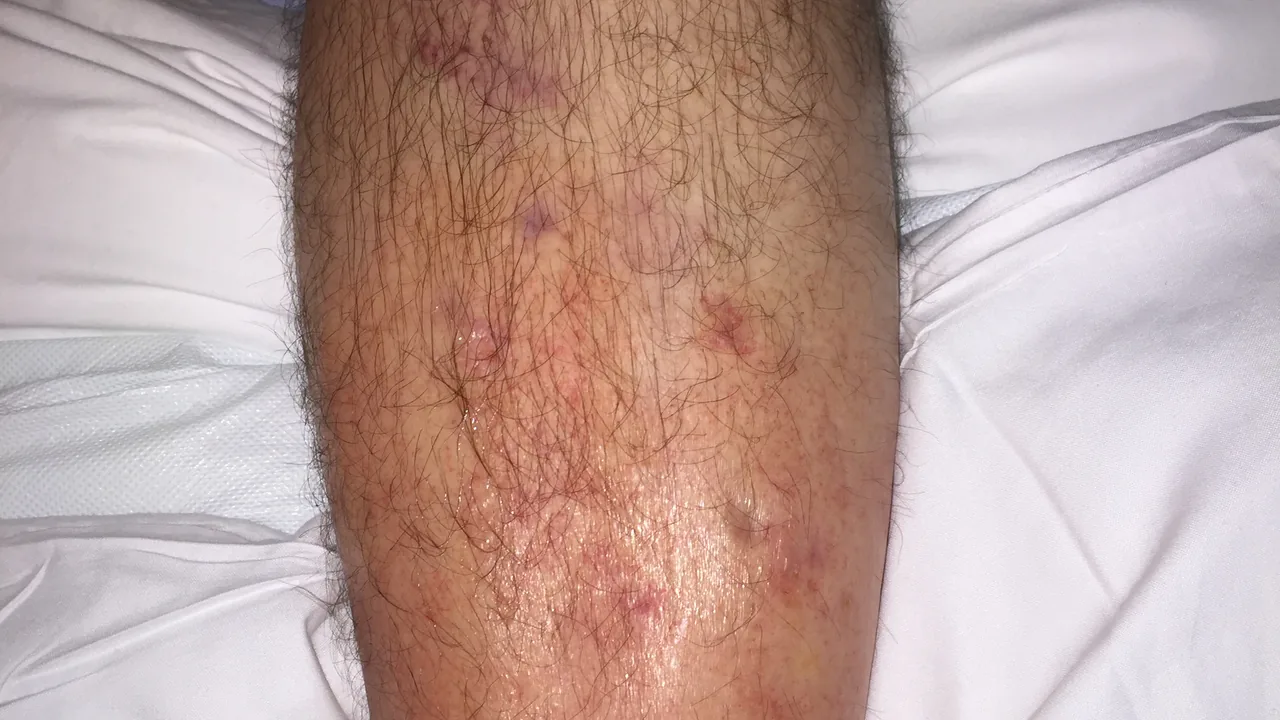 Perna com sinais visíveis de edema, ou inchaço, em imagem editorial