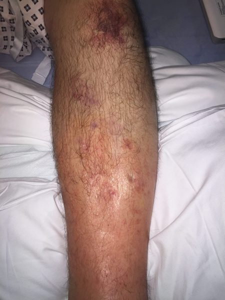 Perna de uma pessoa com inchaço compatível com edema