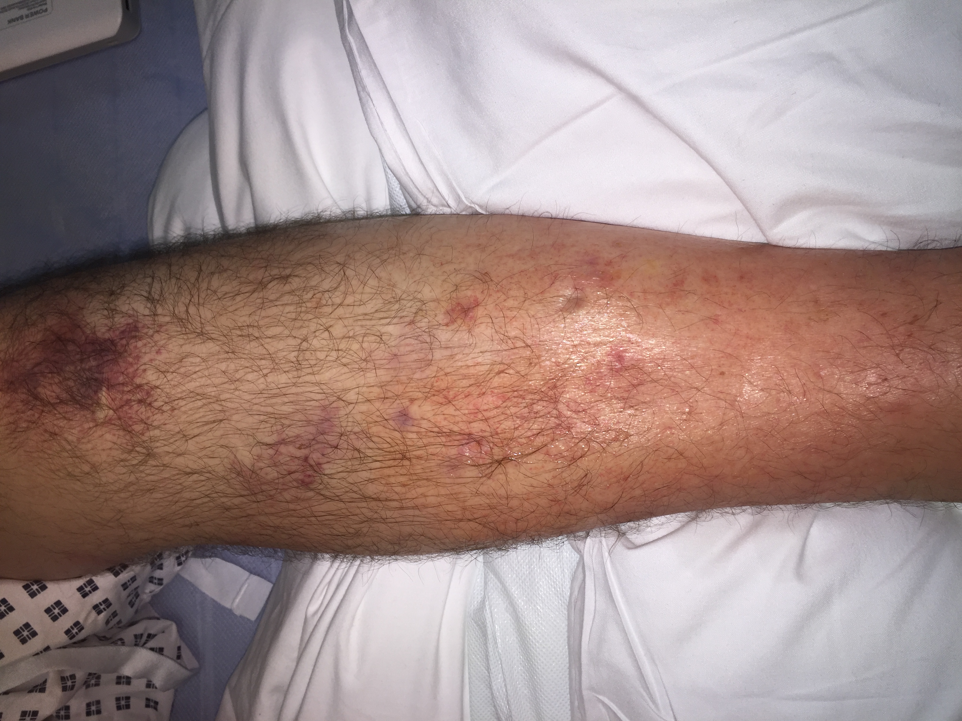 Perna de uma pessoa com inchaço compatível com edema