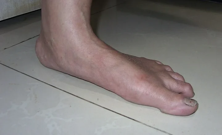 Pé adulto com alteração no arco plantar, usado como referência visual para dor nos pés
